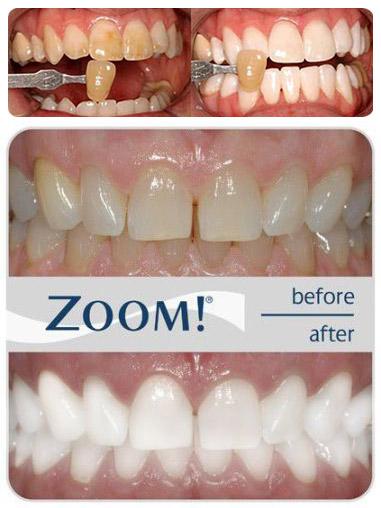 лазерное отбеливания зубов zoom 3